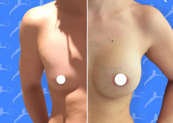 mastoplastica additiva